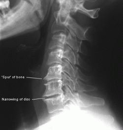 Arthritis and degeneration in the spine - Ridiculously Well